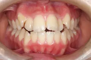 開咬